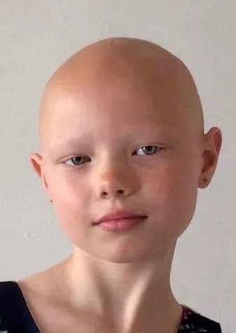 Eight-year-old Girl Embraces Alopecia and Shines Bright