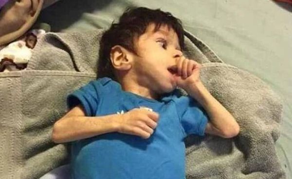 Mom Adopts Skeletal 7-Year-Old Orphan Near Death – Just Wait Until You See Him Today