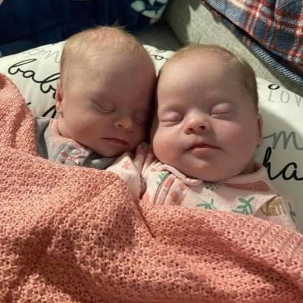 The Birth of Rare Identical Twins with Down Syndrome