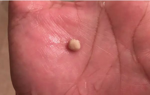 Discover the Fascinating World of Tonsil Stones