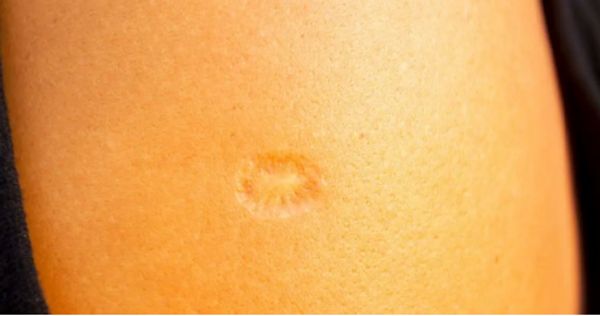 Do You Know The Real Significance Of The Small Scar On The Upper Left Arm?