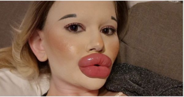 The Quest for the Biggest Lips in the World