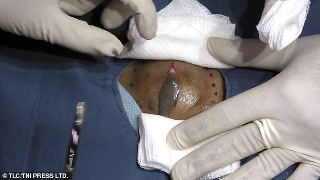 When He Walked In With This Huge Lump, The Doctor Had No Idea What She’d Find Inside