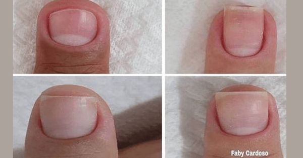 Apple Cider Vinegar: The Secret to Strong and Healthy Nails