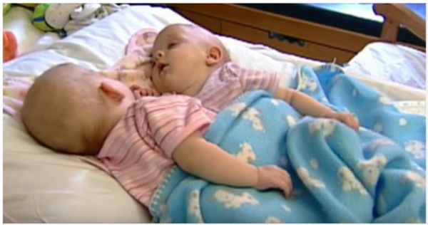 A Miraculous Transformation: Separated Conjoined Twins Thrive