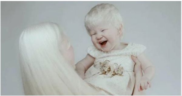 The Remarkable Beauty of Albino Sisters