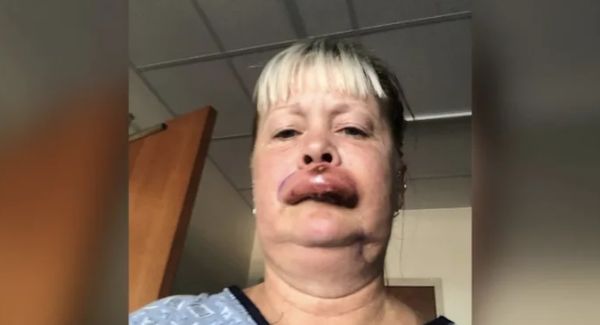 When The Doctors Told Her Why Her Lip Was Swelling Up She Screamed In Horror