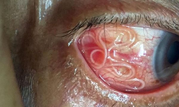 A Disturbing Discovery: Doctors Save Man from Eye-Wriggling Worm