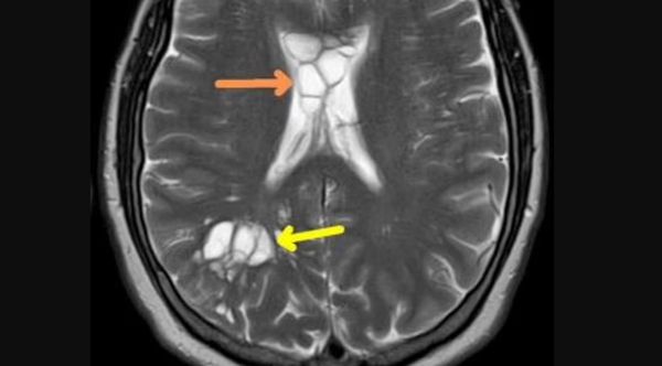 The Surprising Cause of His Migraines: A Pork Tapeworm Infestation