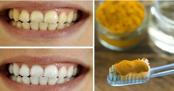 Discover the Natural Wonder of Turmeric for Dental Health