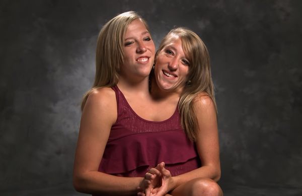 Conjoined Twins Share the Details on How They Get Intimate