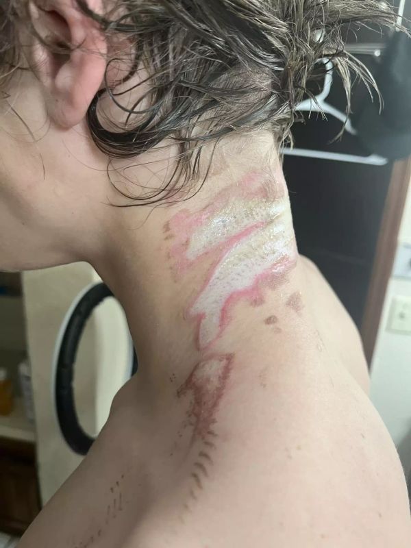 Scars on Rayce's neck will last a lifetime. (Kennedy News and Media)