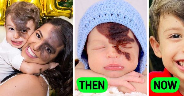 A Mom’s Unwavering Support: Recreating Her Son’s Birthmark