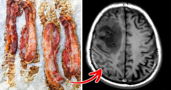 Worm Eggs Found in Man’s Brain After Migraine Suffering – Bacon to Blame!