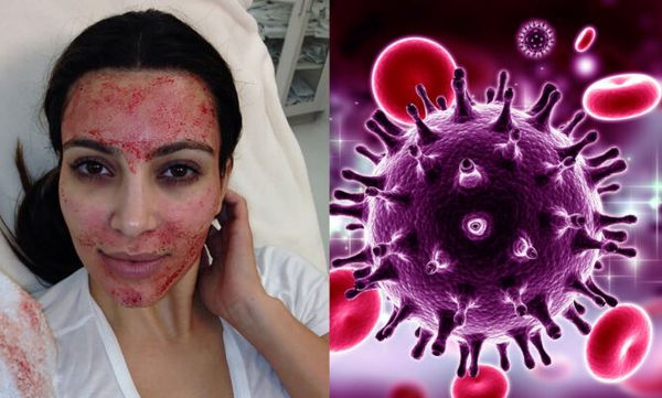 Beware of the Dangers: Vampire Facials Can Lead to Serious Consequences