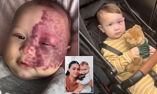 Mom Faces Backlash for Removing Baby’s Birthmark