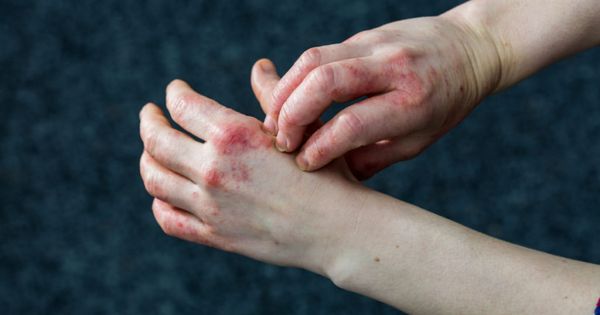 Detailed views of a young woman with dry and stressed red dyshidrotic eczema-covered hands.