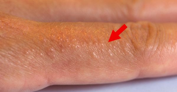 What is Eczema?