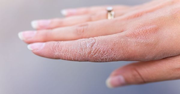 Dry cracked skin macro closeup of index finger of female young woman's hand showing eczema medical condition called dyshidrotic pompholyx or vesicular dyshidrosis.