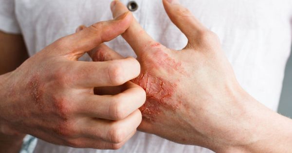 The problem with many people - eczema on hand. White background. Man itchind skin.