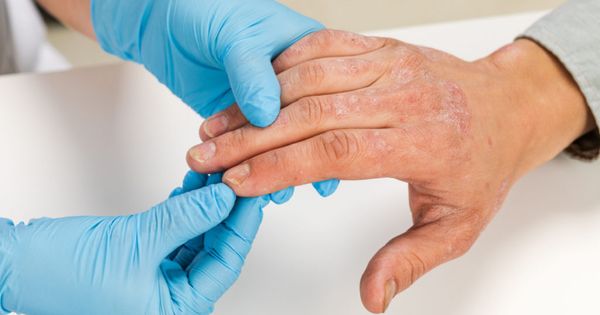 A dermatologist wearing gloves examines the skin of a sick patient. Examination and diagnosis of skin diseases-allergies, psoriasis, eczema, dermatitis.