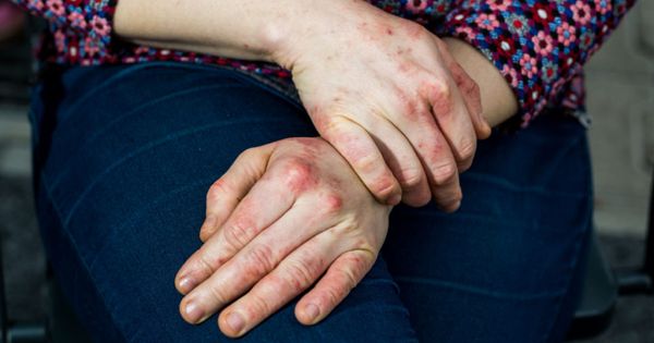 Detailed views of a young woman with dry and stressed red dyshidrotic eczema-covered hands.