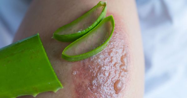 Aloe vera treatment for blisters caused by a fire.