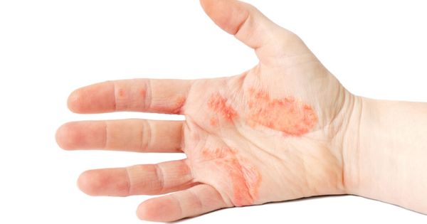 Close-up photo of a hand suffering from eczema.