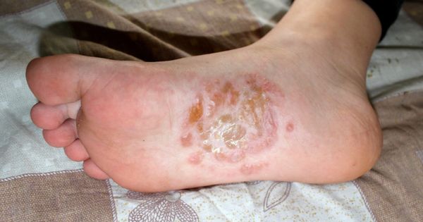 Dyshidrotic eczema (pompholux) of the sole.