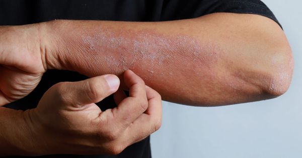 Close up dermatitis on man hand, allergic rash dermatitis eczema skin of a patient. Atopic dermatitis symptom skin detail texture, Fungus of skin. The concept of dermatology.