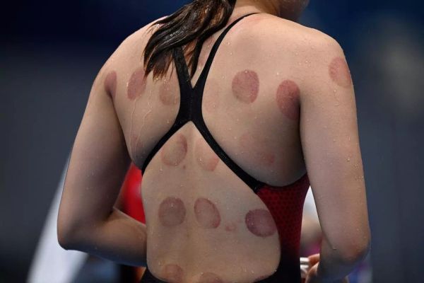 Swimmer with circular bruising