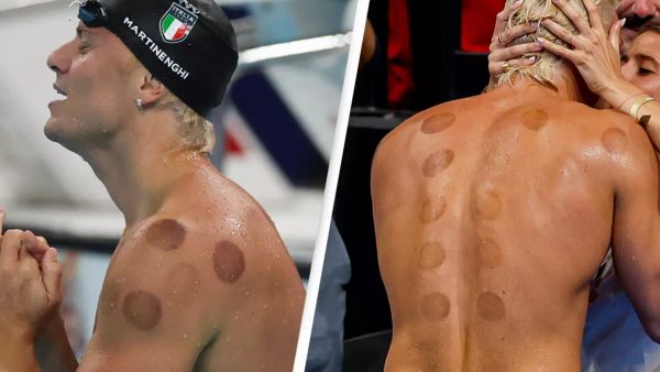 Real reason why Olympic athletes have dark red circles on their backs