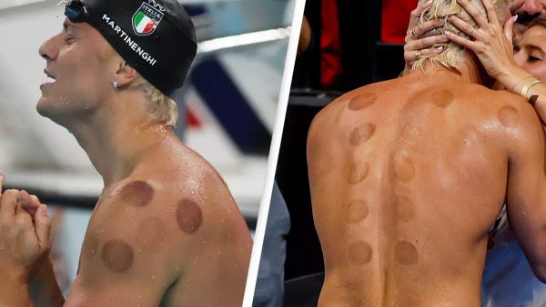 Why Do Olympic Swimmers Have Dark Red Circles on Their Backs?