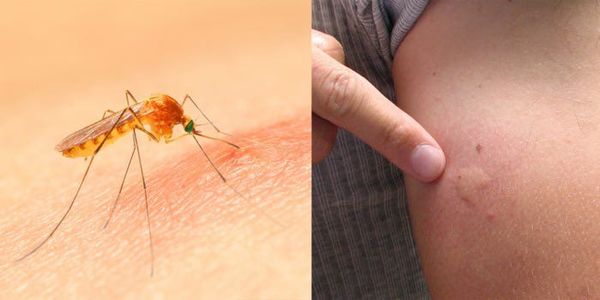 Methods to Relieve Itching from Mosquito Bites