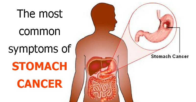 Why You’re Absolutely Going to Want to Ignore These Stomach Cancer Symptoms (Or Not)