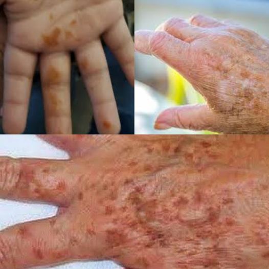 Rediscovering Radiance: Naturally Removing Dark Stains from Your Hands